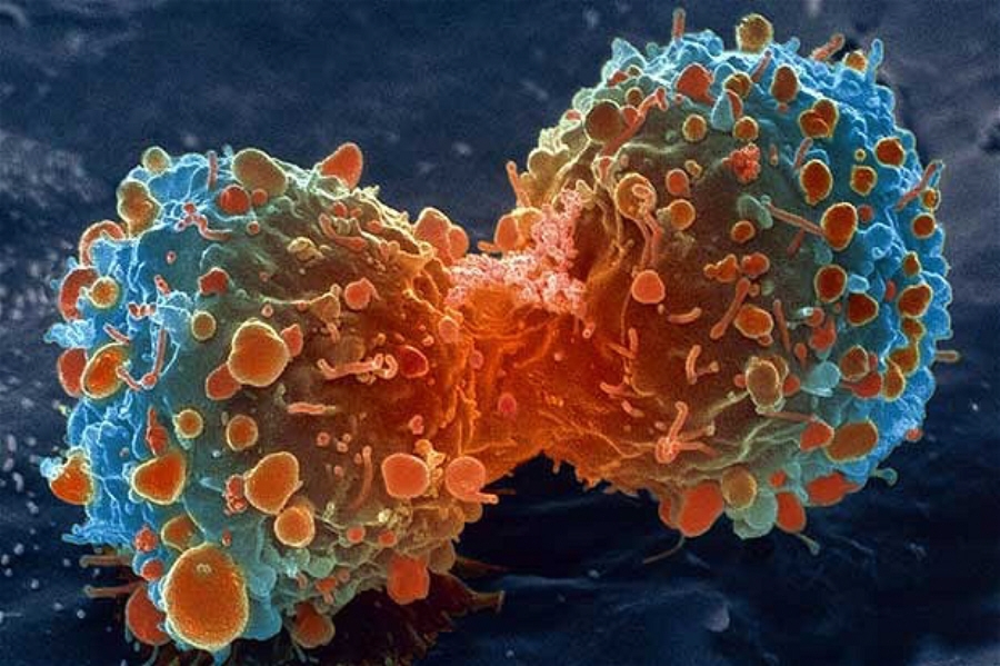 Ο αρχαιότερος καρκίνος του κόσμου είναι 11.400 ετών!