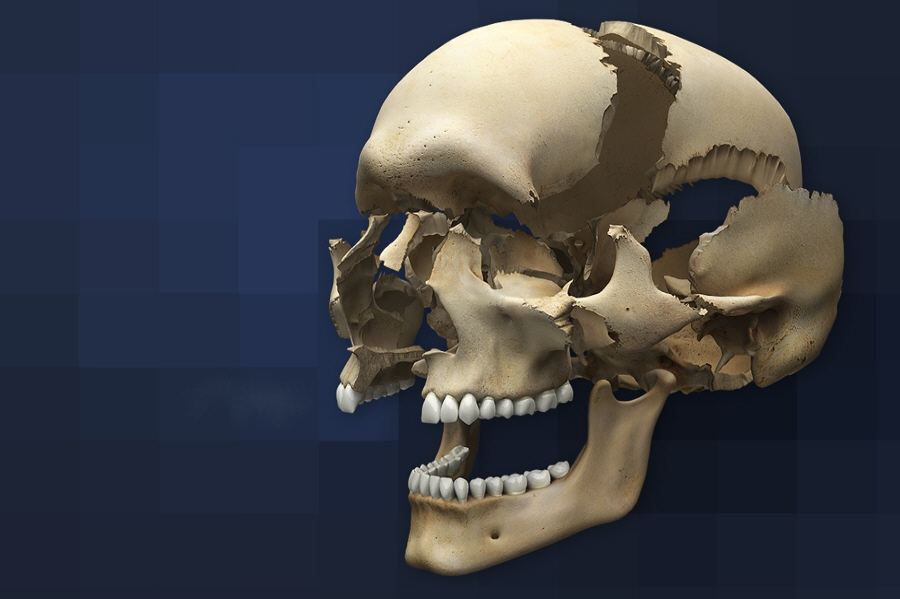 Γιατροί «εκτύπωσαν» για ασθενή νέο 3D πρόσωπο!