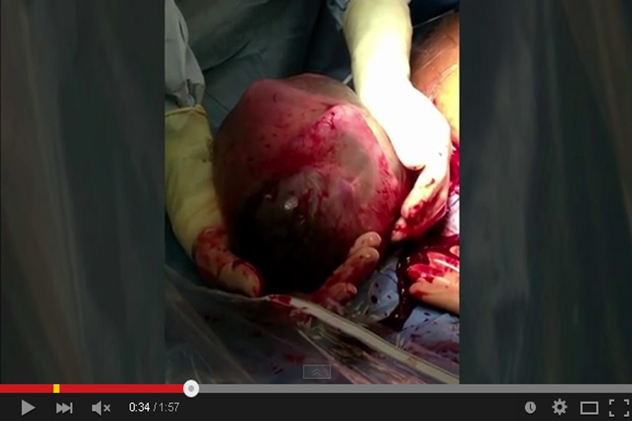 Δείτε το συγκλονιστικό βίντεο με τη γέννηση μωρού μέσα στον αμνιακό σάκο