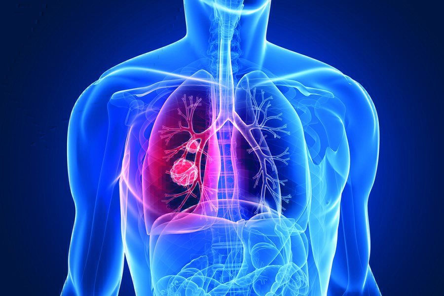 Εξετάζεται νέα θεραπευτική επιλογή για σπάνιο καρκίνο του πνεύμονα
