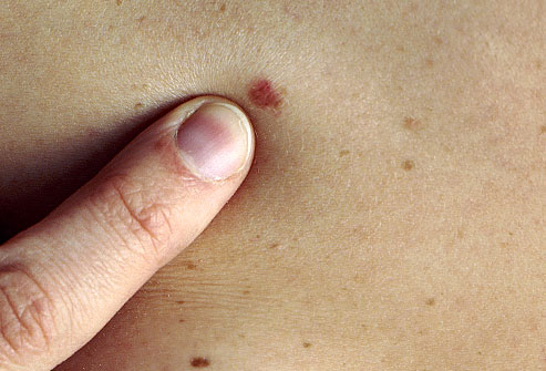 Αυξημένο κίνδυνο καρκίνου του δέρματος δείχνουν πάνω από 11 ελιές στο μπράτσο