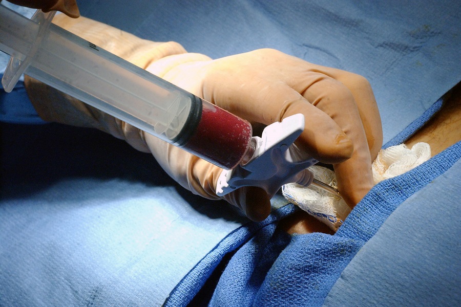 Νέα διαδικασία αποζημίωσης της μεταμόσχευσης μυελού των οστών