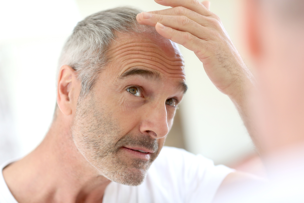 Περίπου 300 γονίδια σχετίζονται με την απώλεια μαλλιών