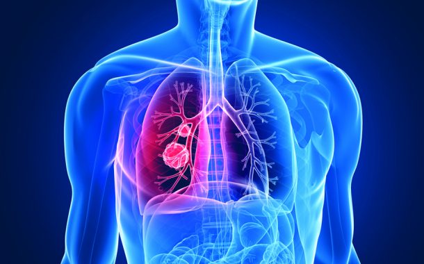 Ελπίδες για σπάνιο καρκίνο του πνεύμονα