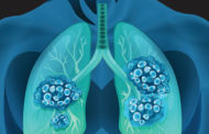 Νέα θεραπεία για ασθενείς με μη μικροκυτταρικό καρκίνο του πνεύμονα