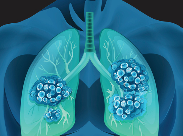Καλά τα νέα για τους ασθενείς με μη μικροκυτταρικό καρκίνο του πνεύμονα