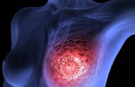 Εντυπωσιακό: Μερικές γυναίκες με καρκίνο του μαστού μπορεί να αποφύγουν τη μαστεκτομή !