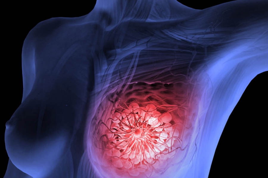Μελέτη με Ελληνική συμμετοχή φέρνει καλά νέα για την αντιμετώπιση του μεταστατικού καρκίνου του μαστού