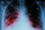 Ελληνική Πνευμονολογική Εταιρεία: Η φυματίωση εξακολουθεί να αποτελεί κίνδυνο