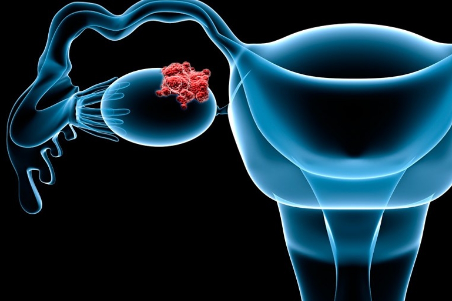 Νέα δεδομένα στην πρόληψη καρκίνου των ωοθηκών