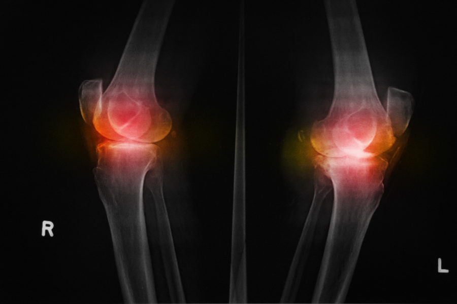 Καινοτομία στην συνδεσμοπλαστική γόνατος στην Βιοκλινική