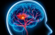 Covid-19: Συχνά τα εγκεφαλικά σε νέους ασθενείς