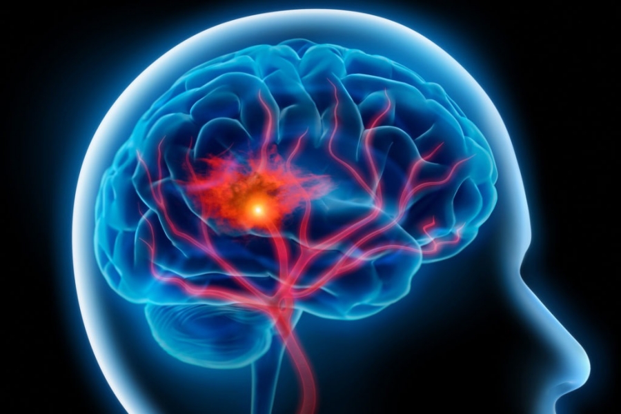 Covid-19: Συχνά τα εγκεφαλικά σε νέους ασθενείς