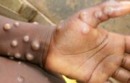 Εθνική Επιτροπή Εμβολιασμών: Δεν χρειάζεται εμβολιασμός του πληθυσμού για την ευλογιά των πιθήκων