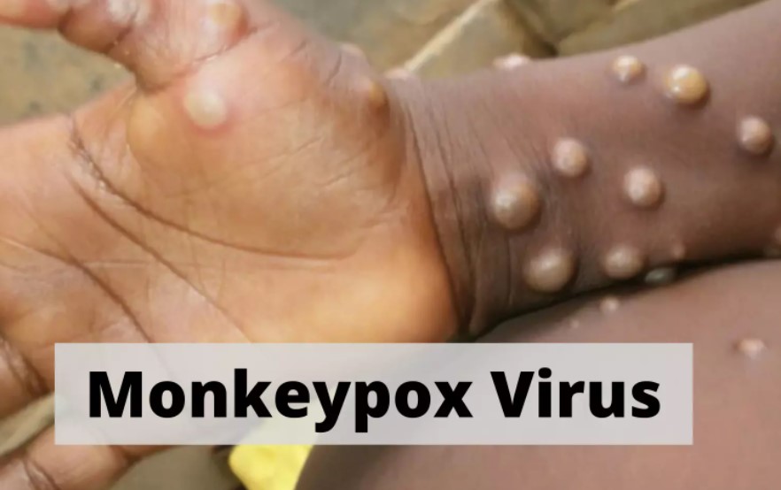 Μόσιαλος: Τι γνωρίζουμε για τον ιό της ευλογιάς των πιθήκων