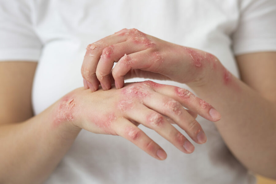 Μελέτη για το BIMZELX: Μακροπρόθεσμη κάθαρση του δέρματος με ψωρίαση