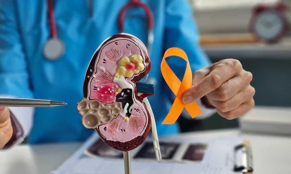 Kidney cancer concept, source: Shutterstock