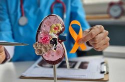 Kidney cancer concept, source: Shutterstock